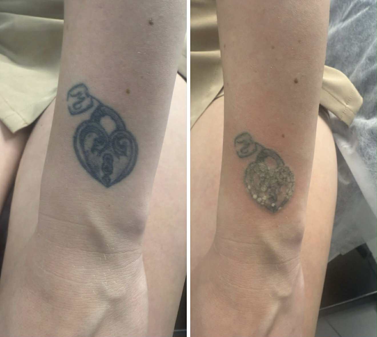 Jak usunąć tatuaż