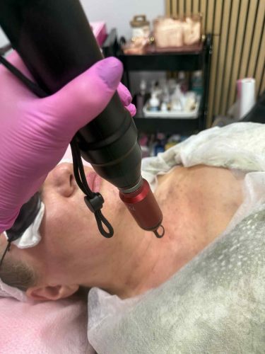 Odmładzanie skóry Chorzele