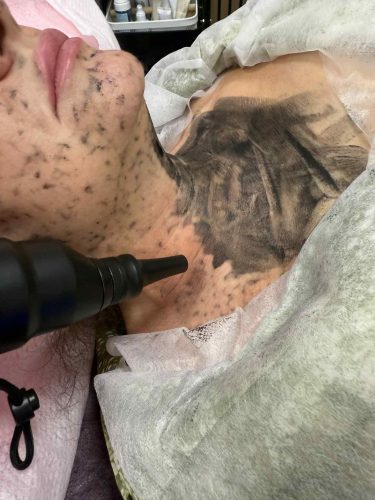 peeling węglowy chorzele